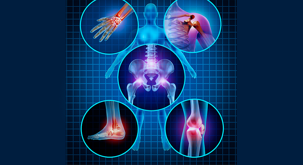 5 tipos comuns de artrite