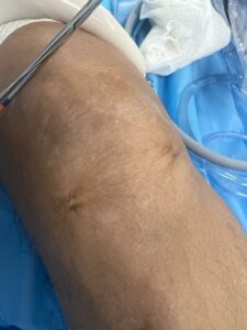 Pós-operatório imediato de artroscopia do joelho