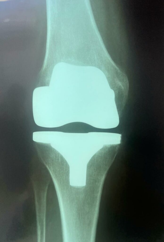 radiografia da prótese total do joelho