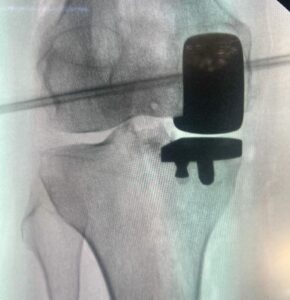 radiografia de prótese unicompartimental do joelho (medial)
