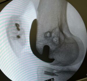 radiografia de prótese parcial do joelho (patelo-femoral)